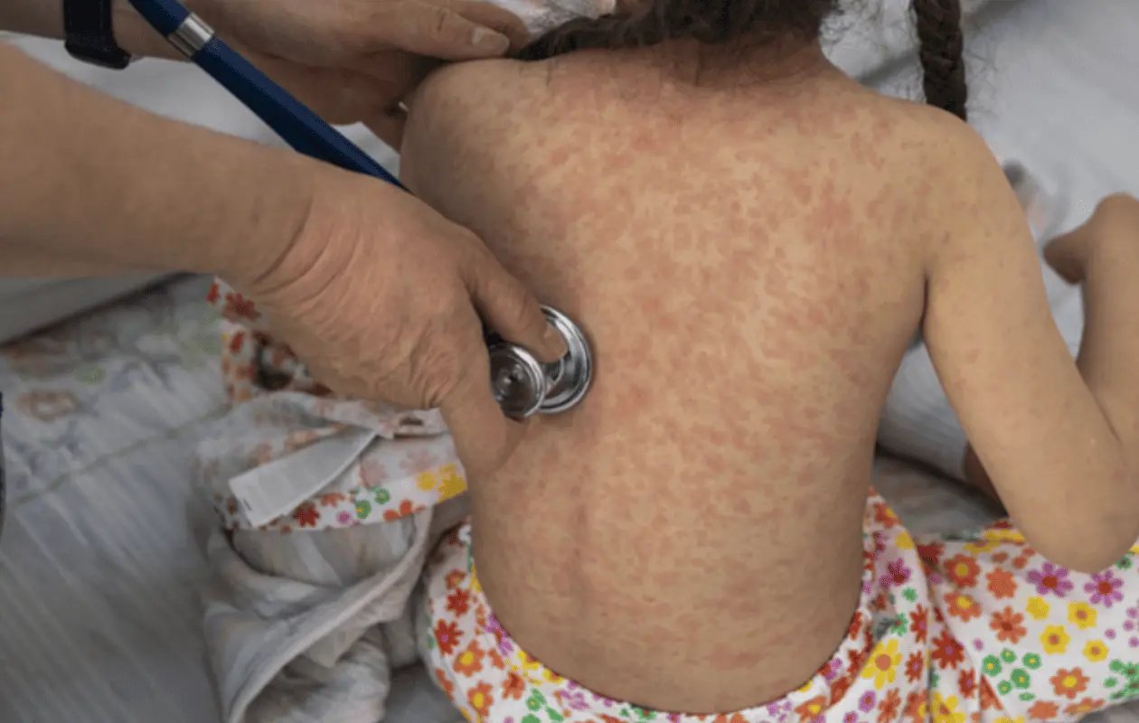 Sarampión en México podría continuar cinco años
