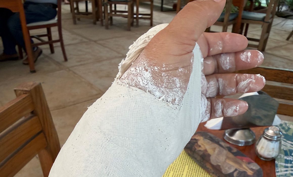 Fernández Noroña sufre fractura tras caída durante caminata en Tepoztlán
